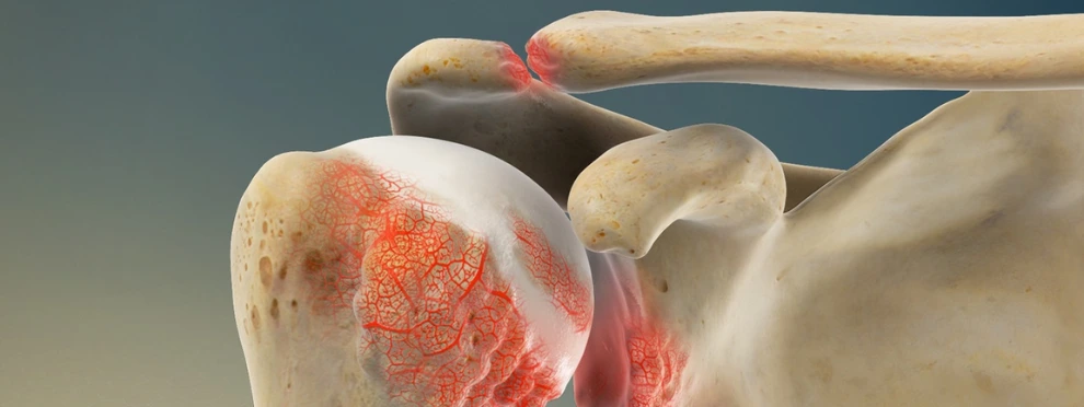 ROTATOR CUFF TREATMENT